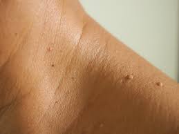Psoriasis and eczema treatment Chennai